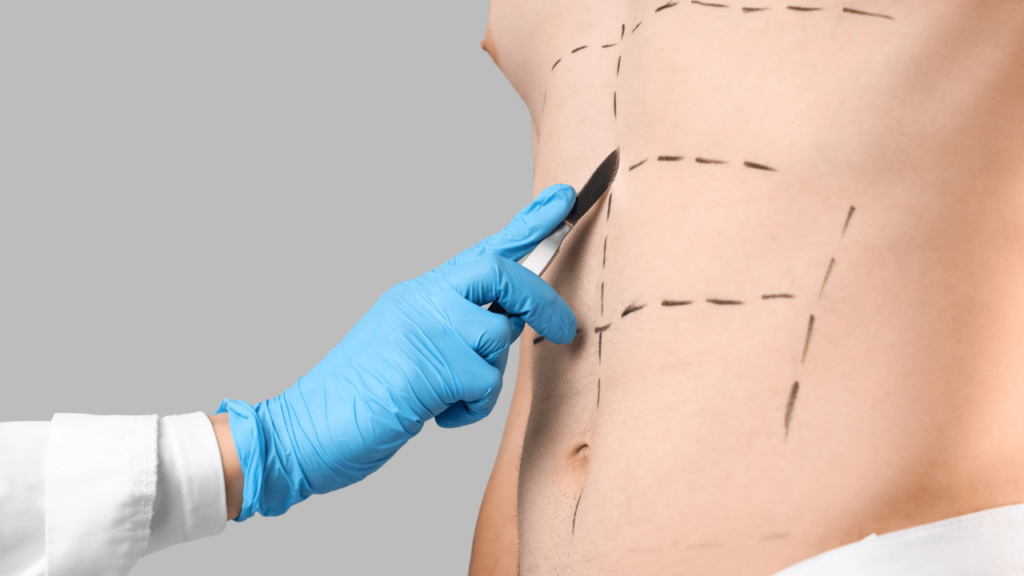 abdominoplastia